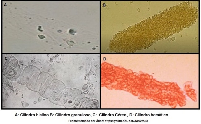 Cetonas cetosis orina