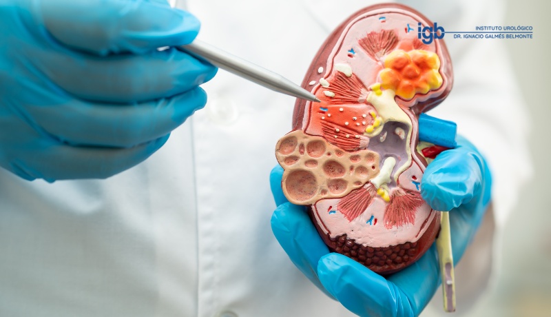 estudio metabolico litiasis renal